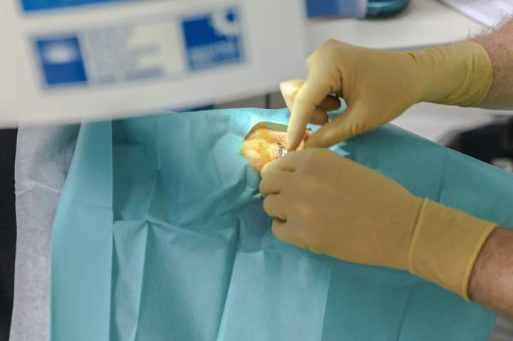 Chirurgie réfractive Port